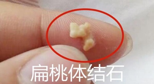 一招讓扁桃體結(jié)石自己排出來(lái)怎么做 扁桃體結(jié)石脫落小妙招有哪些