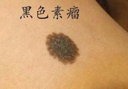 黑色素瘤和普通痣的區(qū)別是什么 怎么判斷是不是黑色素瘤