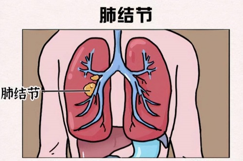 肺部結節要吃藥嗎 肺部有結節可以治愈嗎