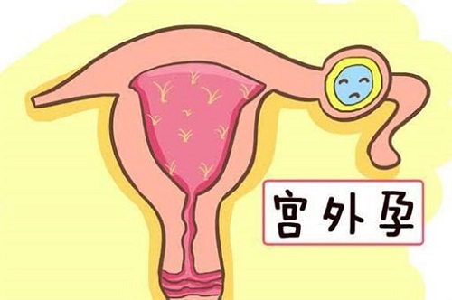 宮外孕癥狀早期是什么 宮外孕癥狀多久能發(fā)現(xiàn)