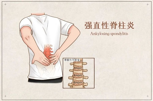 強直性脊柱炎是怎么引起的 強直性脊柱炎5個階段是什么